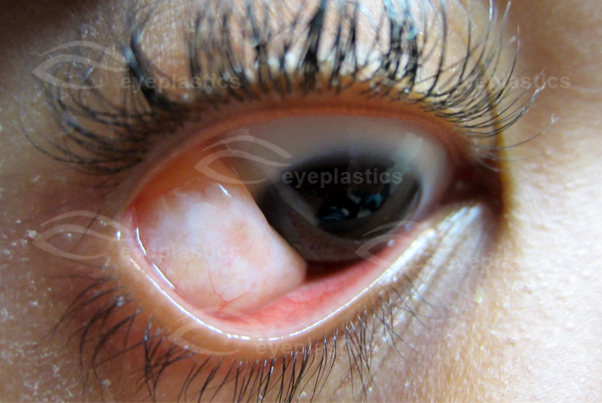 Image depicting eyelid disorders